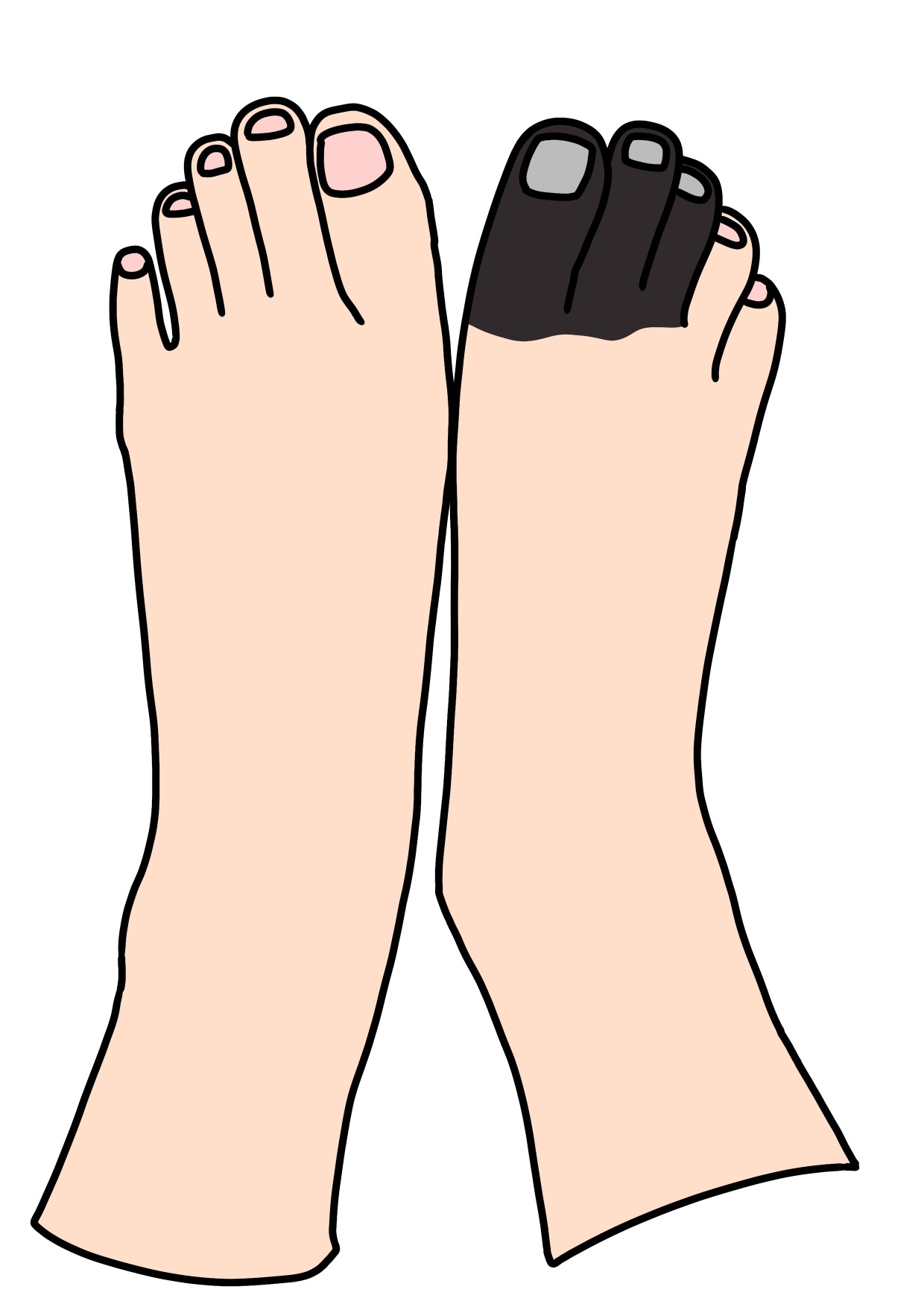 痛風によって足が腐る事はあるのか